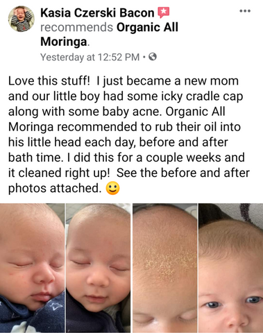 moringa oil before and after babies cradle cap