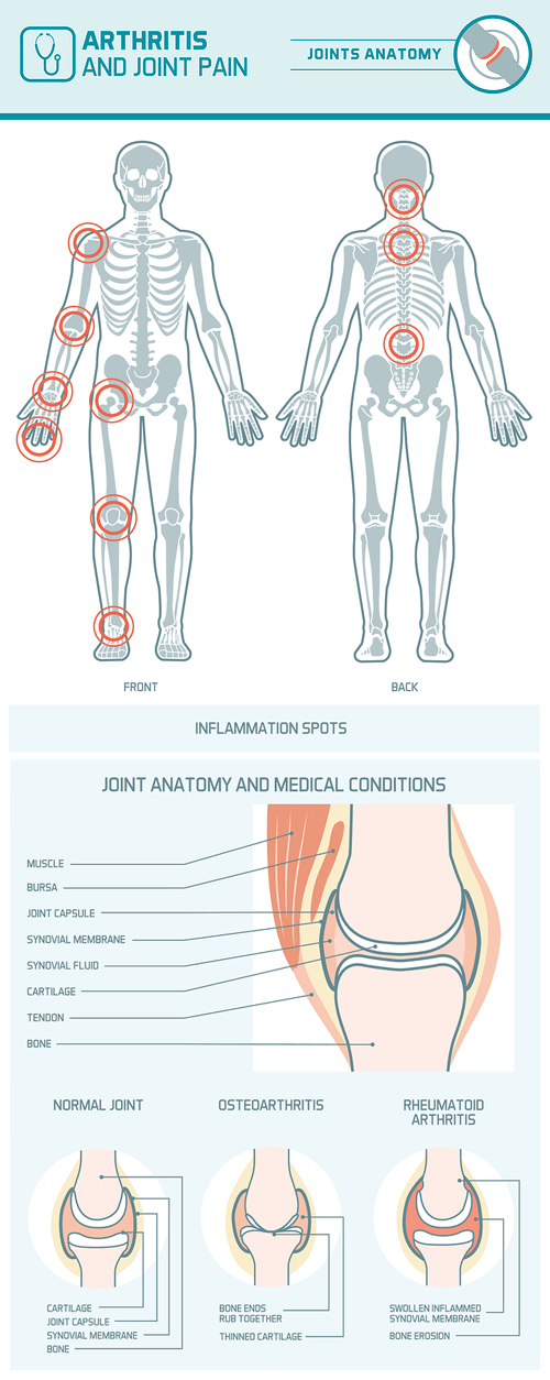 Arthritis Information