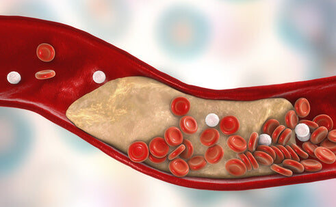 Cholesterol Blockages