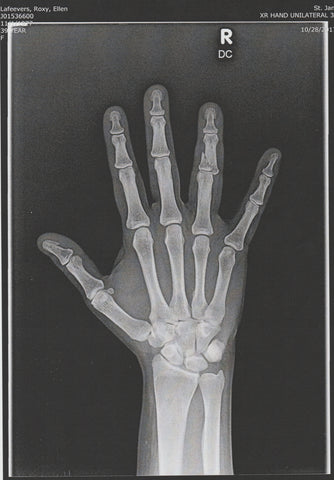 X-ray of Roxy's broken finger