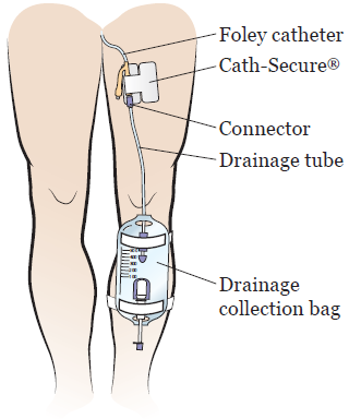 Caring for Your Urinary (Foley) Catheter