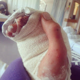 Pongoose blog - Louis hand image post-surgery