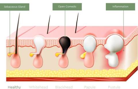 Image of health sebaceous gland, whitehead, blackhead (open comedo), papule, and pustule (inflammation)