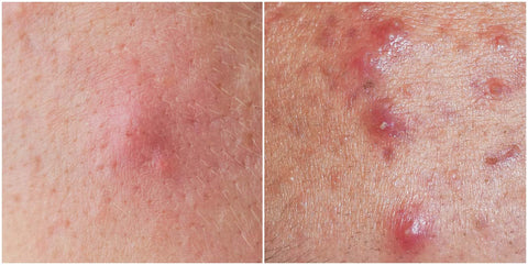 cystic acne