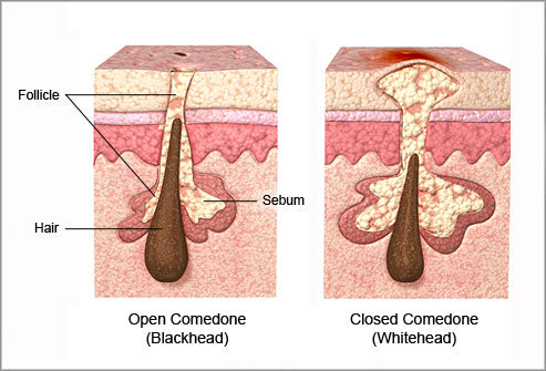 Comedonal acne (whiteheads vs blackheads)