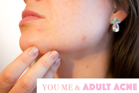 acne-the-truth