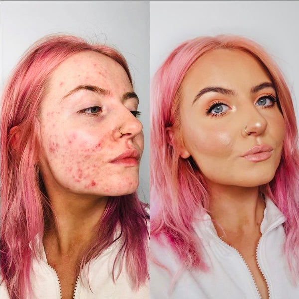 kant vigtig Rejse tiltale Does Makeup Cause Acne | lexinoelbeauty.com