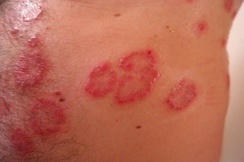 red rash and eczema