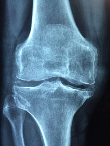 x-ray of knee and cartilage