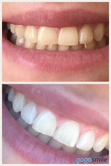 Teeth whitening results 