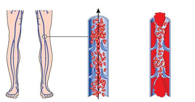 deep vein thrombosis