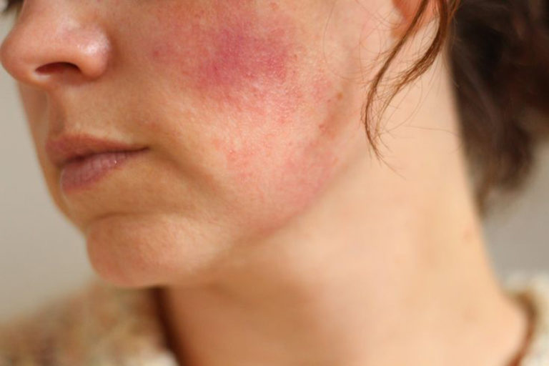 Acne Rosacea And Psoriasis