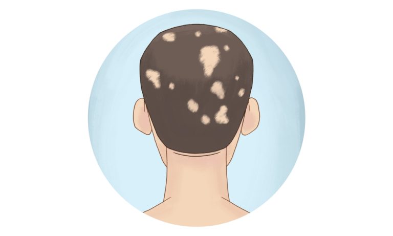 Alopecia Areata