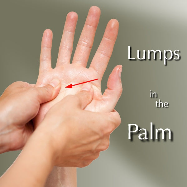 Lumps in the Palms of Your Hands