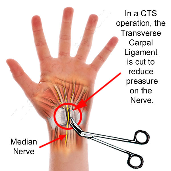  Diagram shows where carpal ligament is cut