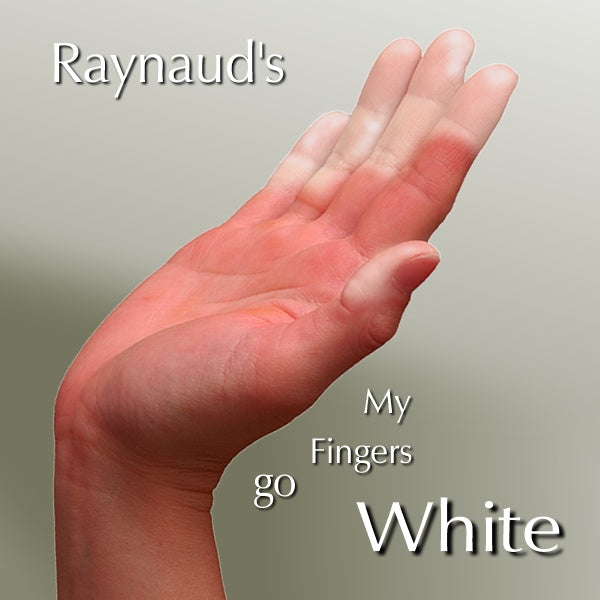 Raynaud's fingers go white