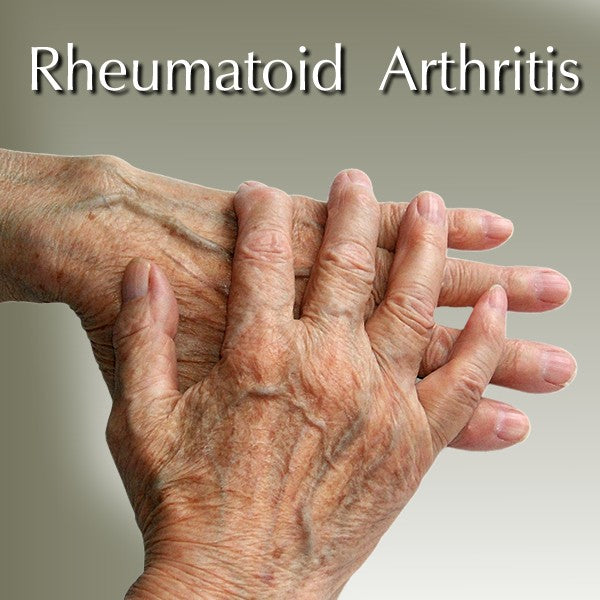 Rheumatoid  Arthritis in Hands