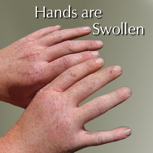 Relief for Swollen Hands