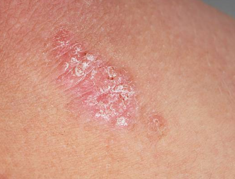 psoriasis halal skin care