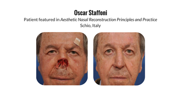 Patient testimonial  review of Aesthetic Nasal Reconstruction book by Dr. Frederick Menick