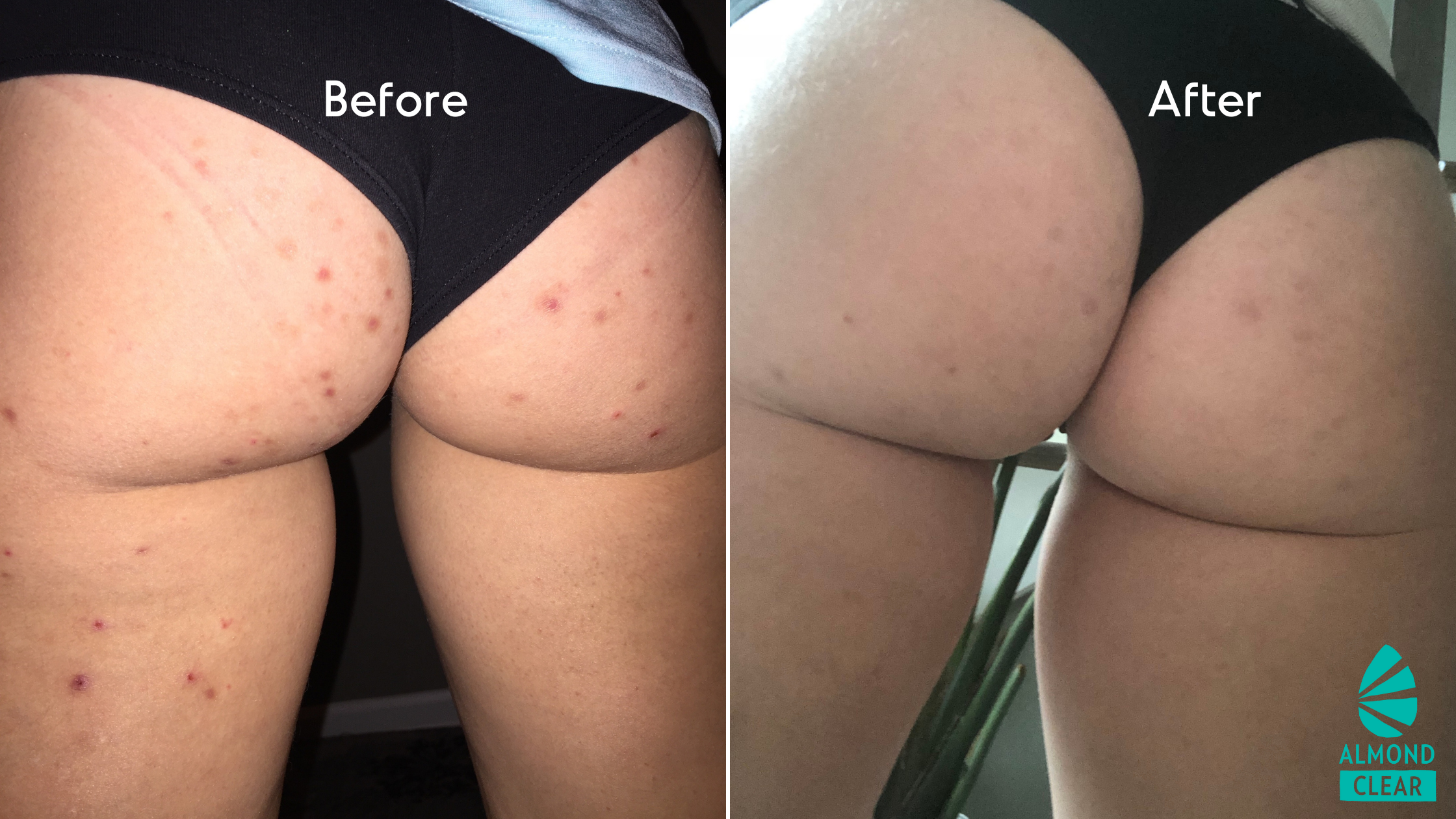 Bevise Utilgængelig passe Red Bumps on the Butt - Causes & Treatment | Almond Clear