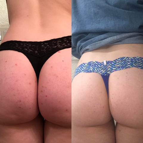 butt acne photos before and after 6 weeks