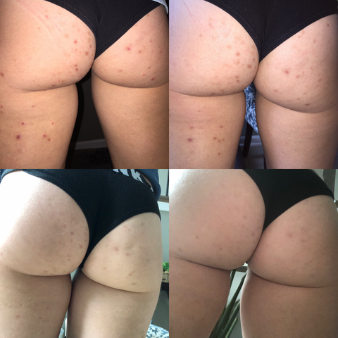 red bumps on butt pictures