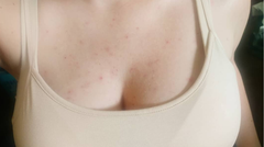 chest acne/folliculitis treatment "after" photo