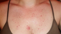 chest acne/folliculitis treatment "before" photo