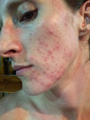 facial acne treatment mandelic acid "before" photo
