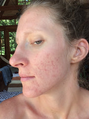 facial acne treatment mandelic acid "after" photo