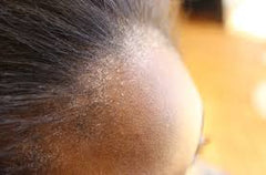 sensitive scalp
