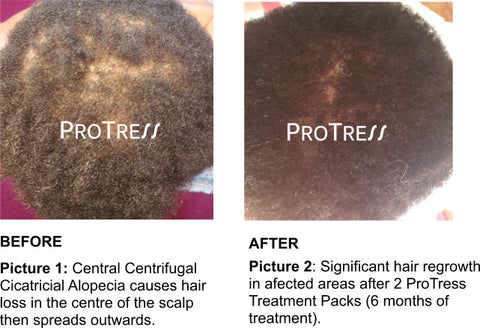 treatment for central centrifugal cicatricial alopecia