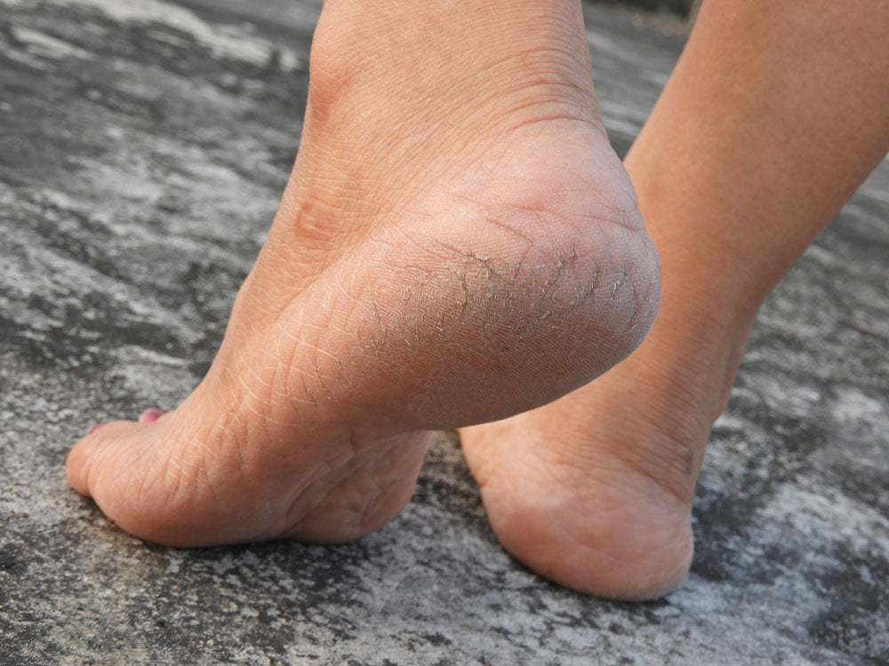 dry skin on soles of feet