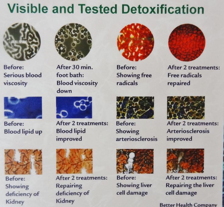 Avantages de la cure de désintoxication ionique