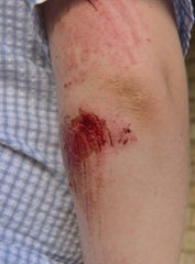 injured-scrapped-bleeding-elbow-221x300