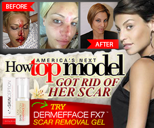 Lisa D'Amato-Top Model- scar treatment- 7 factors to consider before investing in a scar treatment
