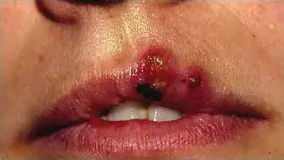 Cold sore crusting stage.