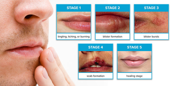 A man touching his lips looking at a diagram of the different stages of a cold sore.