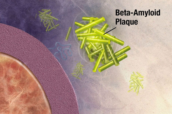 Graphic visualization of beta-amyloid plaques.