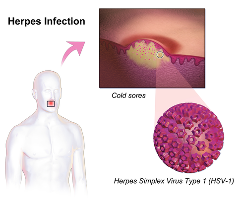 Herpes Simplex Virus Type 1 Diagram
