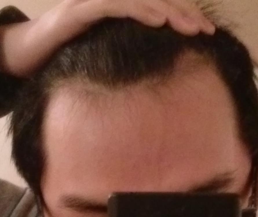 To keep your receding from how hairline How to