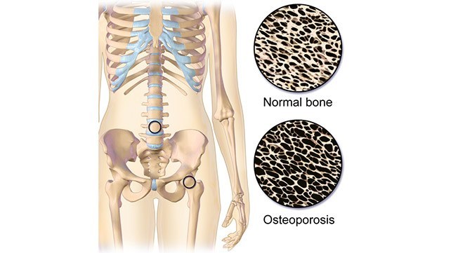 Graphic representation of normal bone and osteoporosis