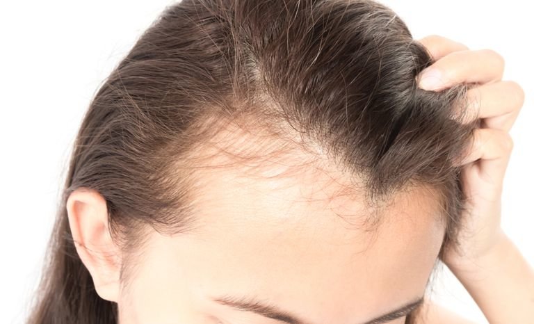 woman with receding hairline.