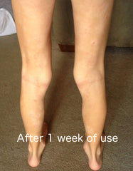 after eczema treatment
