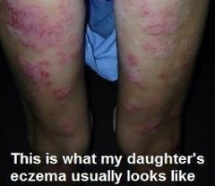 before eczema treatment