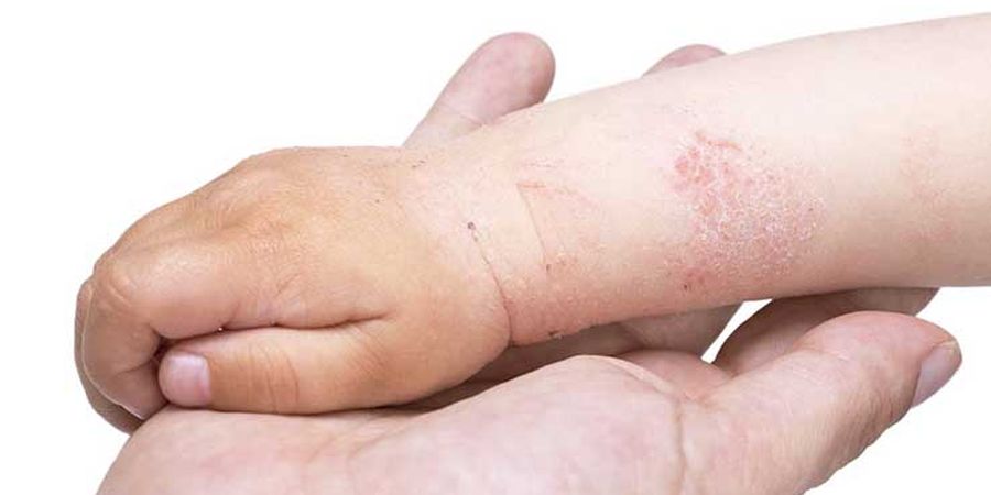 baby eczema