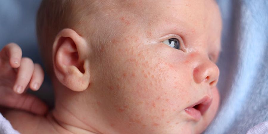common baby rashes