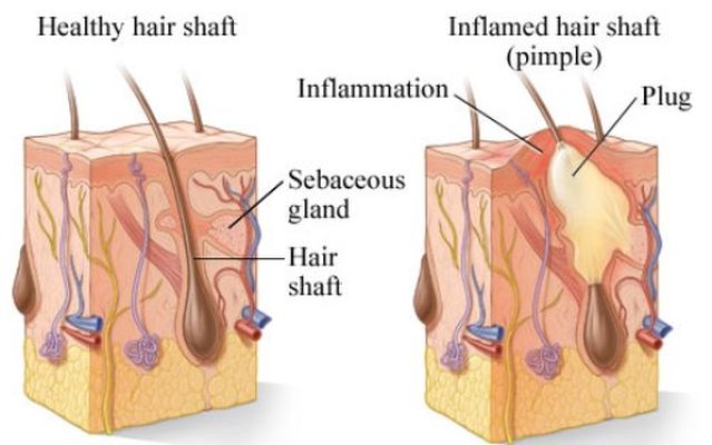 acne diagram 