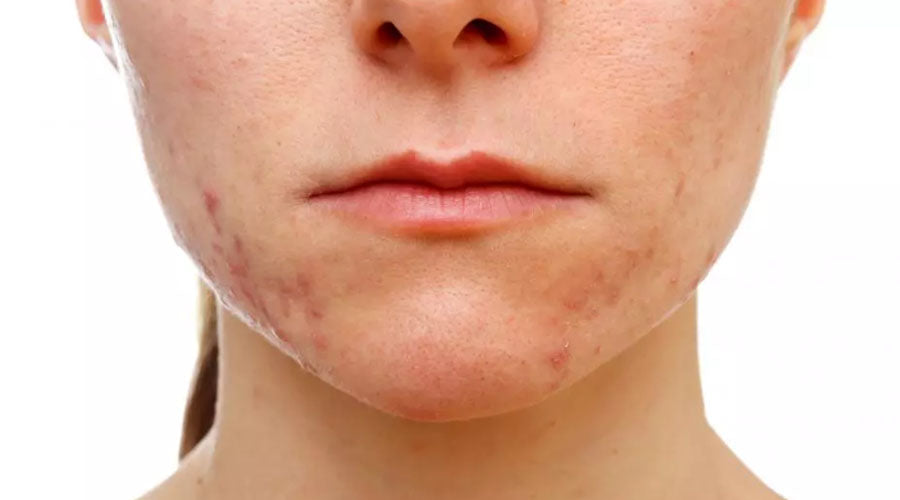 acne creams toxins